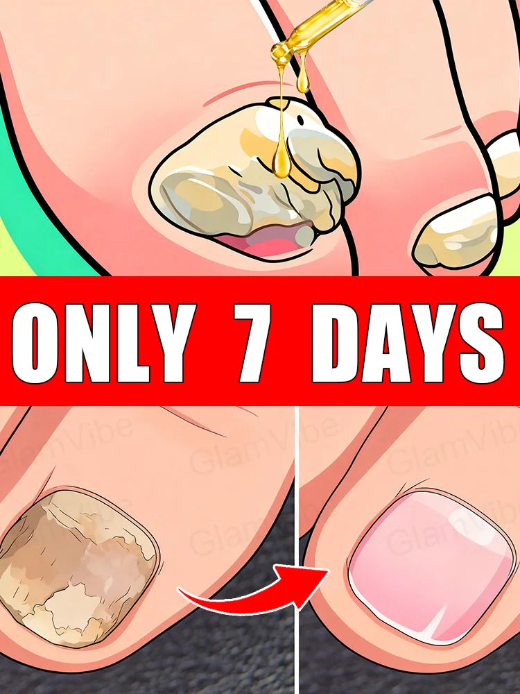 Nail treatment remover by MobilityBuy, featuring a clear liquid in a bottle for fungal nail care.